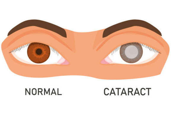 katarak
