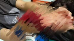 Pengeroyokan di Bilis-Bilis, Tangan Korban Nyaris Putus, Motif Masih Misterius